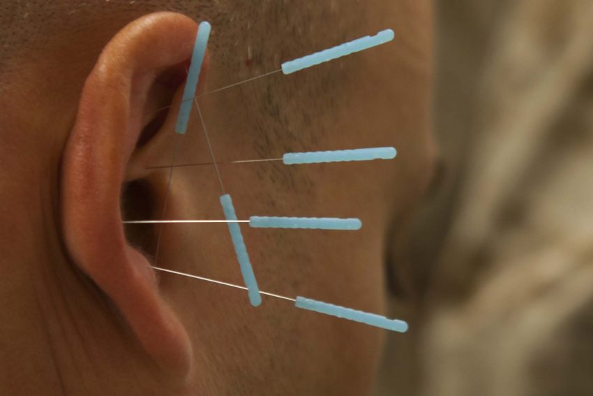 Akupunktur i København for ondt i ryggen eller angst